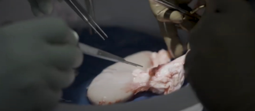 Animal-Human Transplant: Pig Kidney Survives in Human for Over a Month